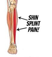 Shin Splint